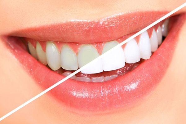 Kem đánh răng Crest giúp làm trắng sáng răng hiệu quả hơn các loại kem đánh răng thông thường